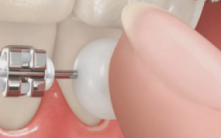 Воск стоматологический для брекетов