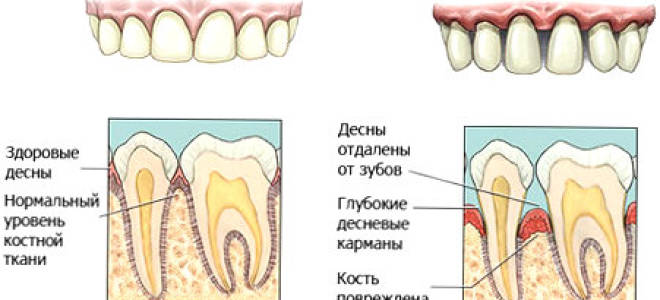 Симптомы болезни десен