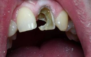 Больно ли выдирать коренной зуб