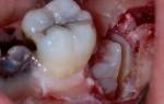 Почему после удаления зуба опухла щека