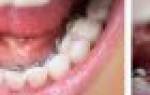 Пульсирующая боль в зубе после пломбирования