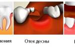 Как долго держится опухоль после удаления зуба