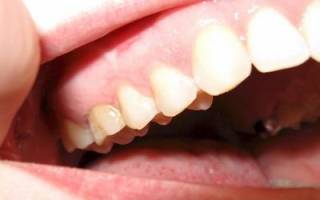 Больно ли удалять зуб с кистой