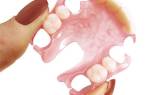Протезирование одного зуба без обточки соседних зубов