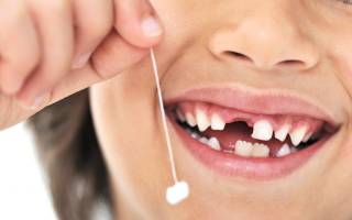 Детское протезирование молочных зубов