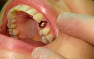 Что такое вкладка в стоматологии под коронку