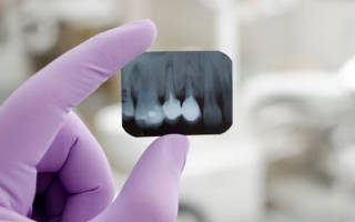 Сколько раз можно делать рентген зубов