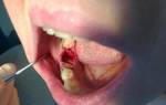 Сколько держать тампон после удаления зуба