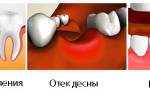 Болит удаленный зуб
