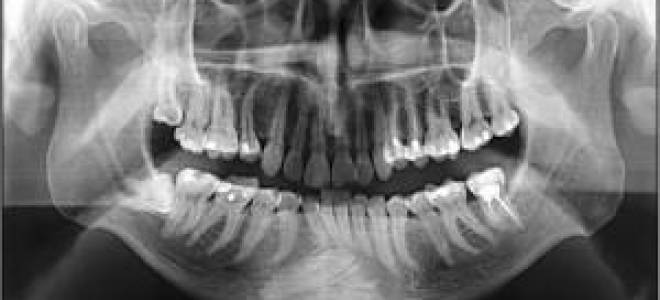 Как часто можно делать рентген зубов