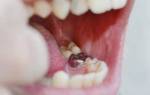 Альвеолит после удаления зуба симптомы лечение