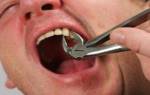 Как вытащить зуб без боли