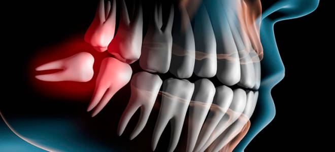 Что означает зуб мудрости