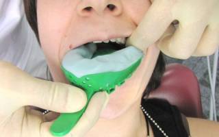 Силиконовые зубные протезы что это такое