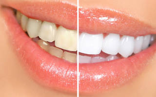 Как перекись водорода влияет на зубы