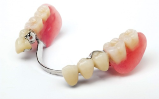 Бюгельный протез зубов – виды, отзывы о продукте