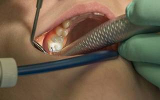 Лечение зубов на поздних сроках беременности
