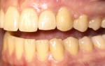Почему клыки желтее остальных зубов