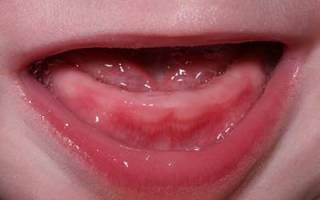 Средства при прорезывании зубов у детей