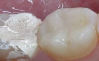 Зачем в зуб кладут мышьяк