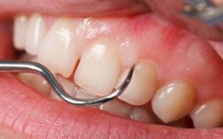 Лечение зуба под коронкой