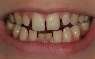 У ребенка большая щель между передними зубами